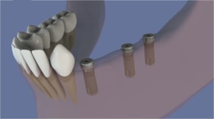 Bridge transvissé de 4 dents sur 3 implants